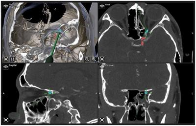 Prognostic factors of traumatic optic neuropathy based on multimodal analysis—Especially the influence of postoperative dressing change and optic nerve blood supply on prognosis